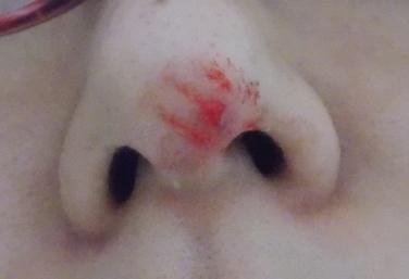 噛まれた私の鼻
