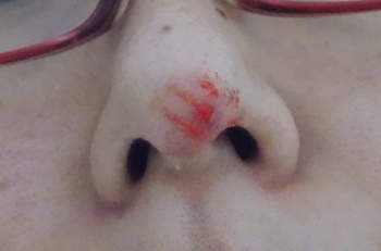 噛まれた私の鼻
